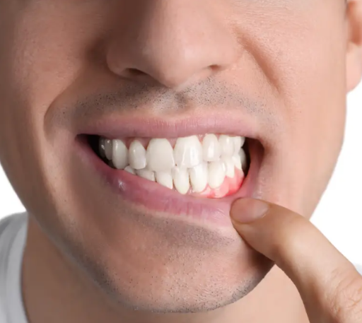 تحلیل لثه: علل، پیشگیری، درمان‌ها و پژوهش‌های نوین