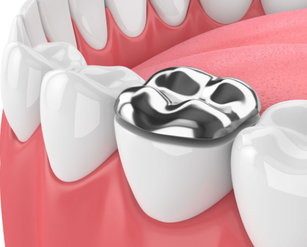 آمالکپ در دندانپزشکی: بررسی جامع و مقایسه با آمالگام